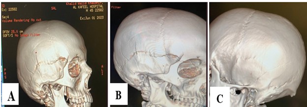 Figure 1: Sample photos were evaluated. A true-positive picture in lateral view that identifies a fractured parietal bone. B: False-positive picture identifying a lateral vascular groove view. C: False-negative picture failing to identify left diastatic fracture lambdoid suture seen in the anterior posterior view's left orbit region