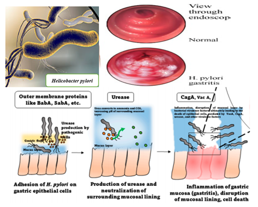 Helicobacter pylori: Challenges and Advances in Diagnosis, Treatment, and Eradication